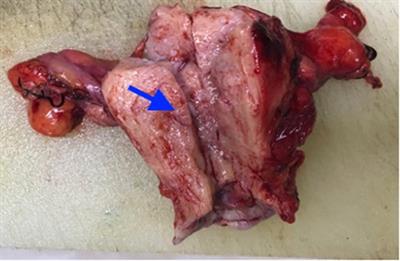 Gastric-type Mucinous Carcinoma with an Abnormal Increase of CA199: A Case Report and Literature Review